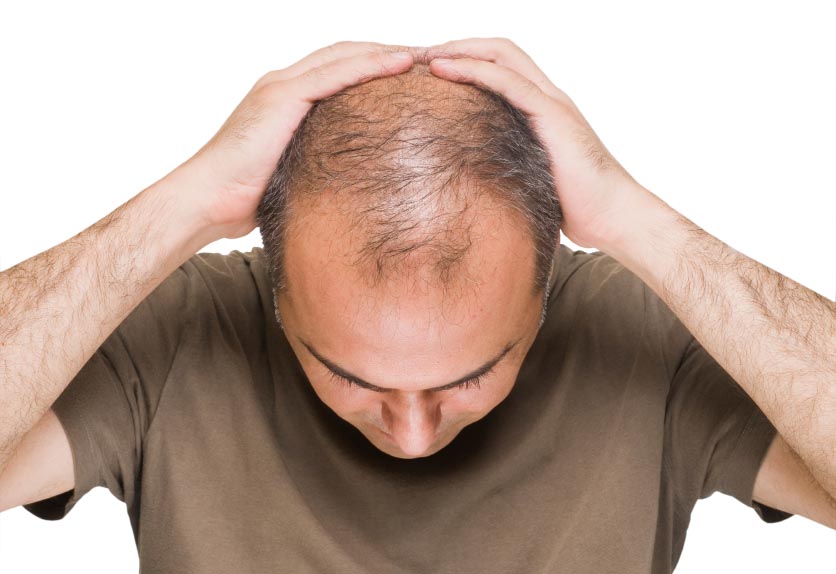 کشف درمان ریزش ارثی موی سر