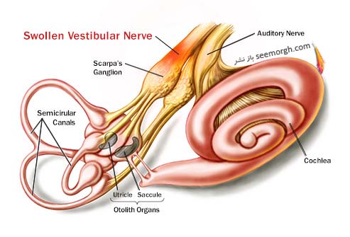وستیبولار نورونیت Vestibular Neuronitis
