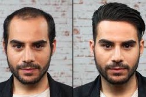 کاشت مو ممنوع!! کشف جدیدترین علت ریزش مو توسط نخبه ایرانی