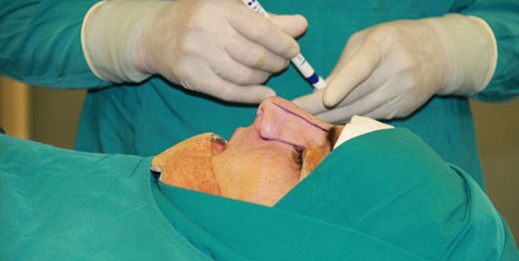 30تا 40 درصد مراجعه‌کنندگان برای جراحی بینی نیاز به جراحی دارند