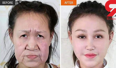 چهره دختر جوان قبل و بعد از جراحی زیبایی