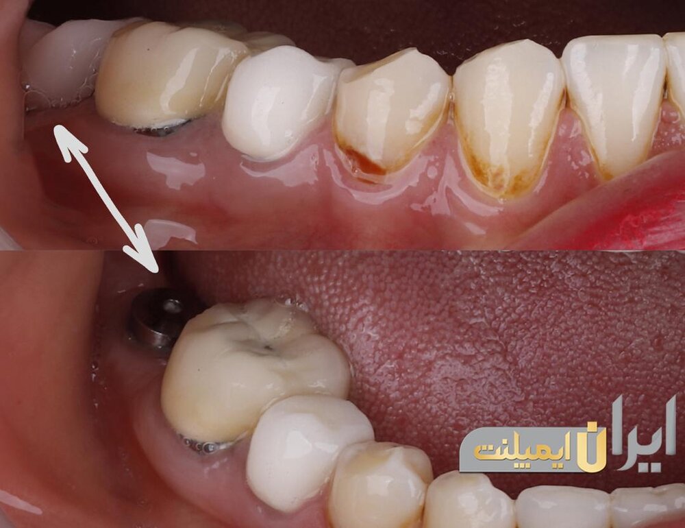 ایمپلنت و کاشت دندان در سعادت آباد/ مرکز ایران ایمپلنت