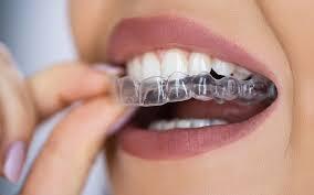 جدیدترین روش ارتودنسی دندان بدون سیم کشی