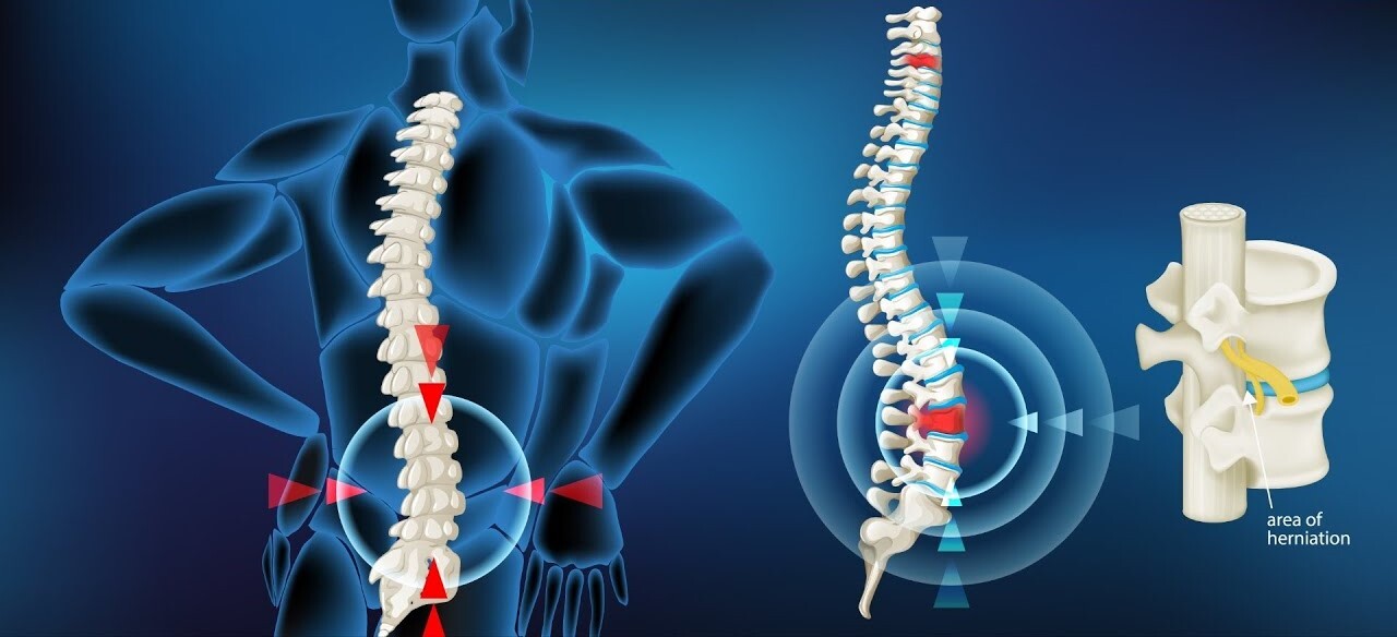 چطور بفهمیم دیسک کمر داریم یا نه؟
