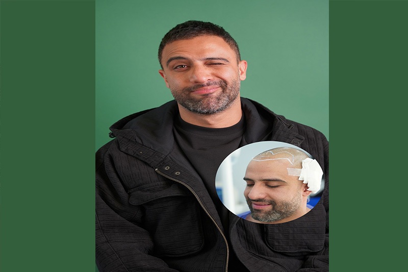 بهترین روش کاشت مو در سال 1404